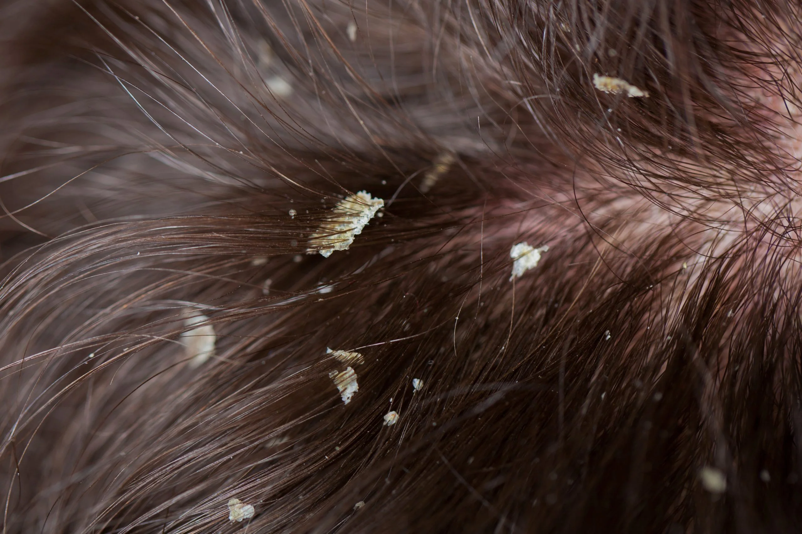 Causes and treatment of dandruff-