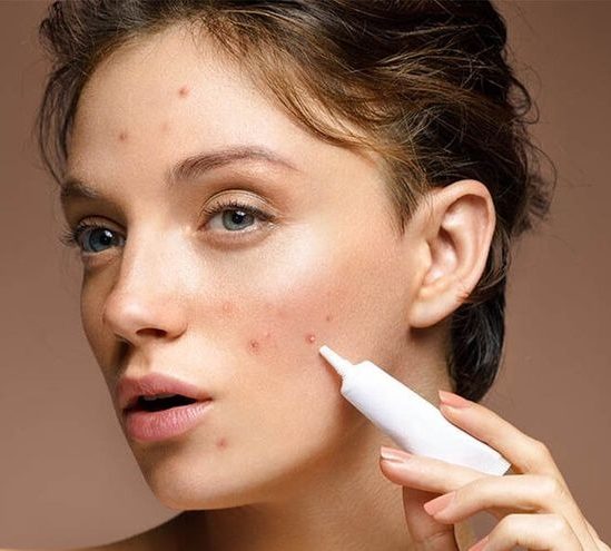 علت جوش صورت چیست؟ از چربی پوست و هورمونها تا استرس و تغذیه. با راهکارهای علمی، درمان قطعی آکنه و حذف جای جوش را یاد بگیرید.