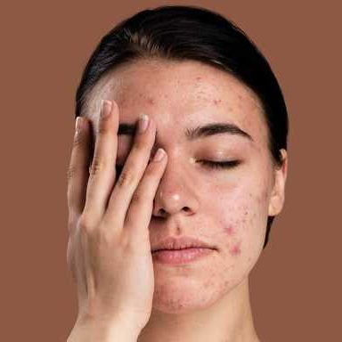 علت جوش صورت چیست؟ از چربی پوست و هورمونها تا استرس و تغذیه. با راهکارهای علمی، درمان قطعی آکنه و حذف جای جوش را یاد بگیرید.