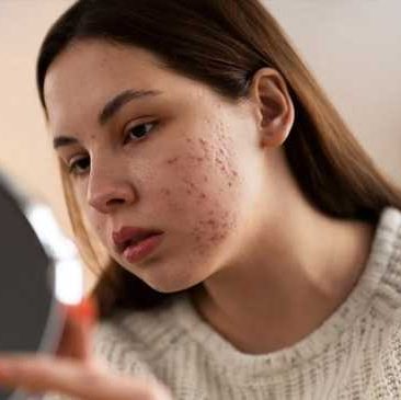 علل و راه های رهایی از جوش و اکنه؛ راهنمای جامع و کاربردی
